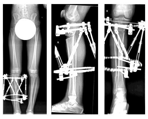 Francesca: Anterior Physeal Arrest w/ Recurvatum Deformity & Shortening 3