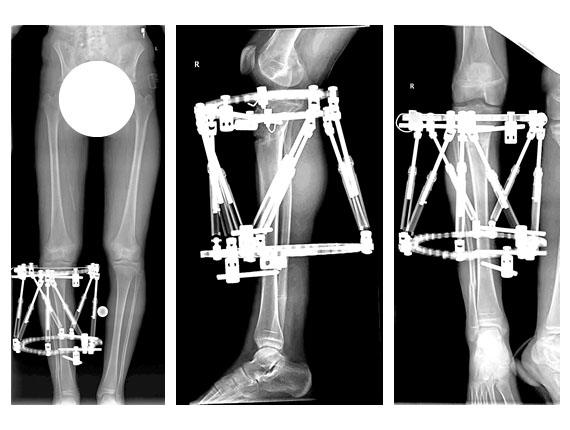 Francesca: Anterior Physeal Arrest w/ Recurvatum Deformity & Shortening 5