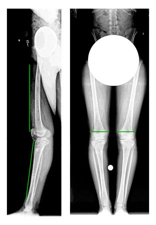 Francesca: Anterior Physeal Arrest w/ Recurvatum Deformity & Shortening 6