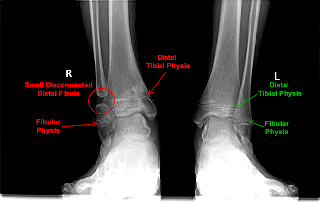 Grace: Varus Ankle & Medial Physeal Bar
